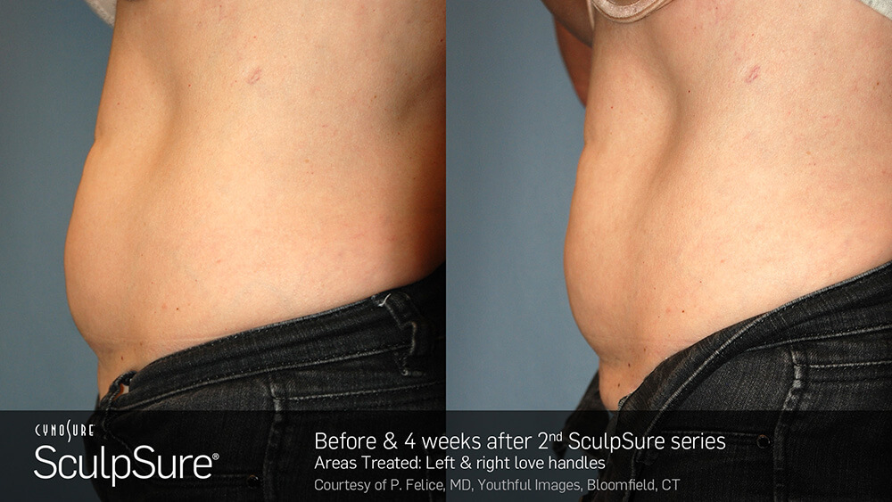 Sculpsure-LASER PERFECTION